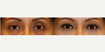 Patient treated with Asian/ Double Eyelid Surgery - Patient treated with Asian/ Double Eyelid Surgery