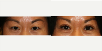 Patient treated with Asian/ Double Eyelid Surgery - Patient treated with Asian/ Double Eyelid Surgery