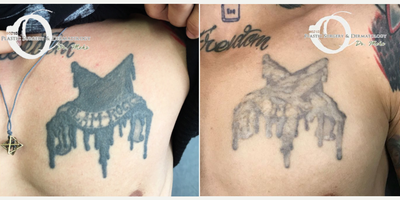 Woman treated with Tattoo Removal - Woman treated with Tattoo Removal, shown after 3 sessions.