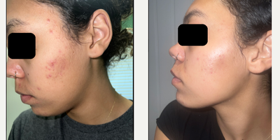 18-24 year old woman treated with Retin-A - Retin-A works by promoting the turnover of skin cells, which helps to prevent the clogging of pores and reduce the formation of acne lesions. It can also help to reduce the appearance of fine wrinkles and mottled skin discoloration, and to make rough facial skin feel smoother.While Retin-A can be very effective, it can also cause side effects, including skin redness, dryness, itching, scaling, mild burning, or worsening of acne during the first 2 to 4 weeks of using the medication. These side effects usually decrease with continued use of the medication.It's important to use Retin-A exactly as directed by your physician and to avoid exposure to sunlight or artificial UV rays, such as sunlamps or tanning beds, while using the medication, as it can make your skin more sensitive to UV rays.