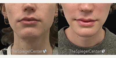 18-24 year old woman treated with Mandible Contouring - 18-24 year old woman treated with Mandible Contouring
