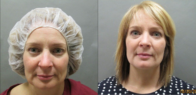 45-54 year old woman treated with ThermiTight - This patient had Thermi RF to her neck and jowls