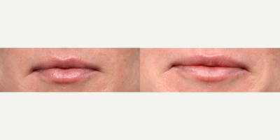 35-44 year old woman treated with Restylane Refyne, Lip Fillers - Wise Med Spa Nurse Practitioner Radhika Patel used Restylane Refyne to subtly enhance this patients lips. Photos were taken 2 weeks after and the patient loves her natural-looking results.