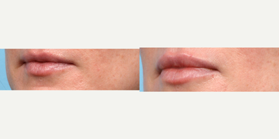 35-44 year old woman treated with Restylane Refyne, Lip Fillers - Wise Med Spa Nurse Practitioner Radhika Patel used Restylane Refyne to subtly enhance this patients lips. Photos were taken 2 weeks after and the patient loves her natural-looking results.