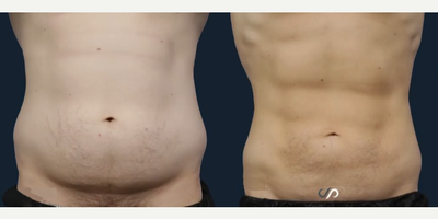 Man treated with Power-Assisted Liposuction (PAL) - Man treated with Power-Assisted Liposuction (PAL)