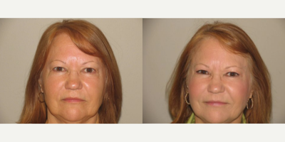 Woman treated with Bellafill - Bellafill