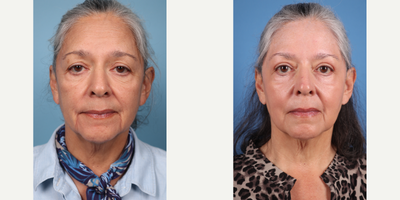 70 year old woman treated with Phenol Peel & Facial Fat Transfer to Temples, Tear Troughs, and Cheeks - Dr.Sukkar performed a Phenol Peel & Facial Fat Transfer to Temples (1cc per side), Tear Troughs (1cc per side), and Cheeks (5cc per side) to this 70 year old patient.