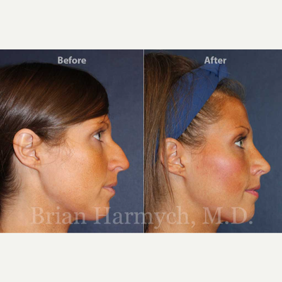 Chin Liposuction before and after photo