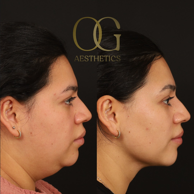 Chin Liposuction before and after photo