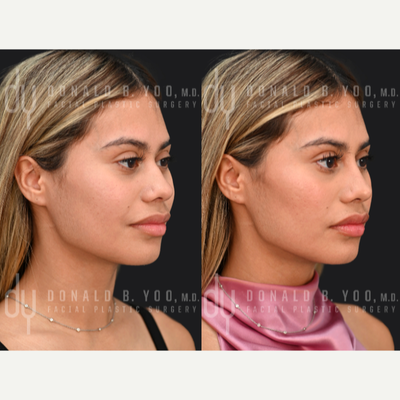 Nonsurgical Nose Job before and after photo