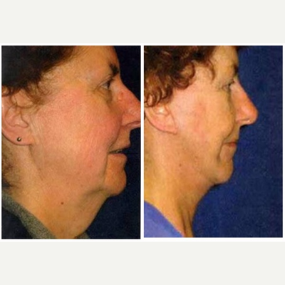 Facelift before and after photo