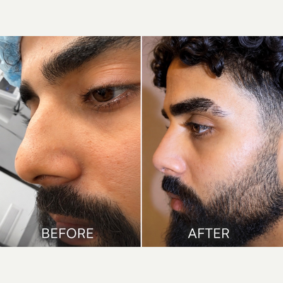 Rhinoplasty before and after photo