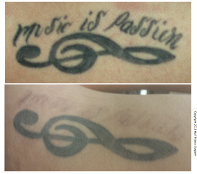 PicoSure before and after photo