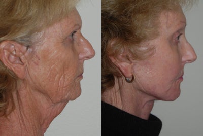 Facelift before and after photo
