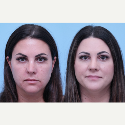Revision Rhinoplasty before and after photo