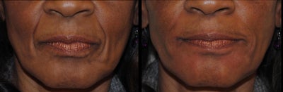 Radiesse before and after photo
