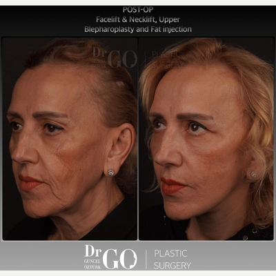 Facelift before and after photo