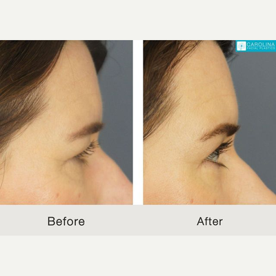 Brow Lift before and after photo