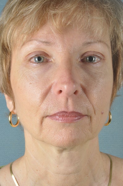 The Modern Grandma's Guide to Using Botox - Azul Cosmetic Surgery and  Medical Spa