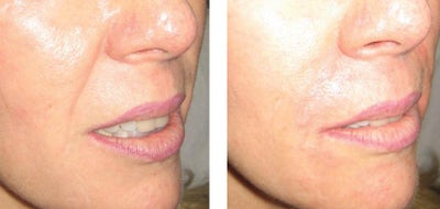 Radiesse before and after photo