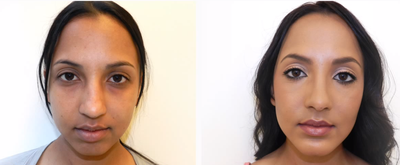 Chin Implant before and after photo