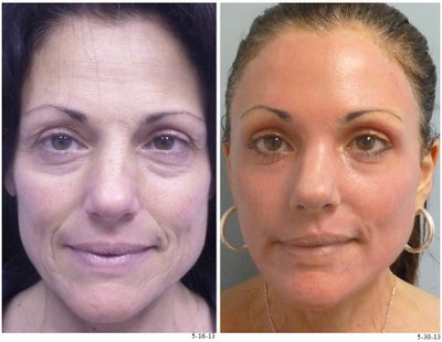Laser Resurfacing before and after photo