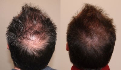 PRP for Hair Loss before and after photo