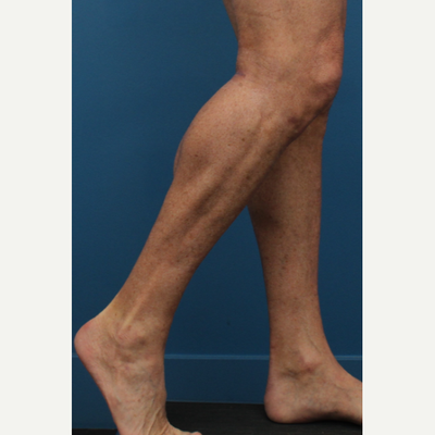 Calf Implants: Surgery, Recovery, Side Effects & Scars