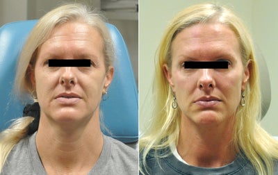 Cheek Fillers before and after photo