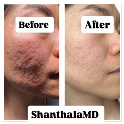 UltraClear Laser before and after photo