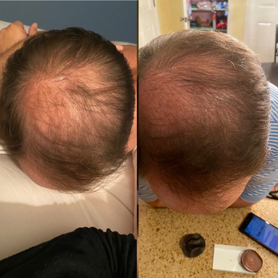 PRP for Hair Loss before and after photo