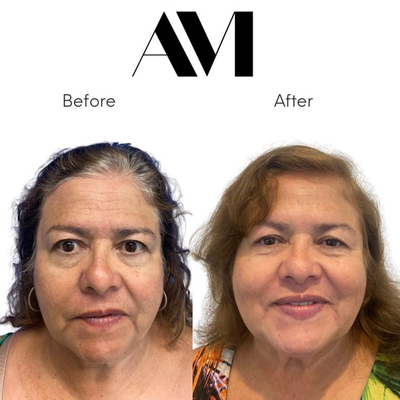 Botox before and after photo