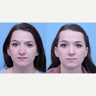 Revision Rhinoplasty before and after photo