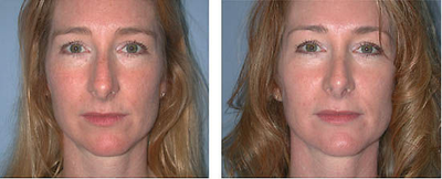 Rhinoplasty before and after photo