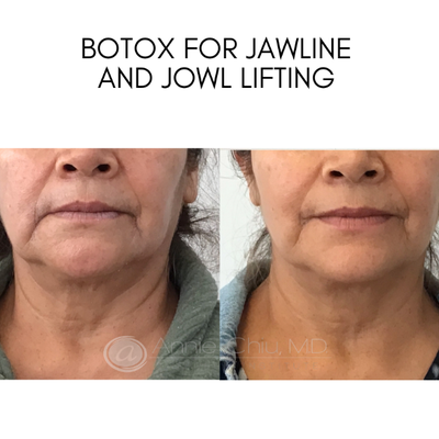 Botox before and after photo