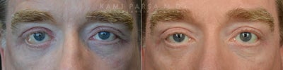 Canthoplasty before and after photo