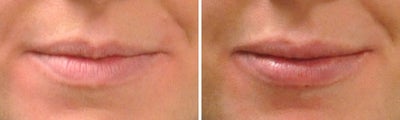 Lip Fillers before and after photo