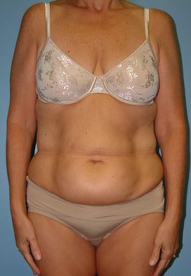 Post Surgery Liposuction Faja Partially removable built-in bra