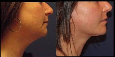 Neck Lift before and after photo