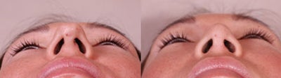 Asian Rhinoplasty before and after photo