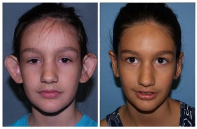 Ear Surgery before and after photo