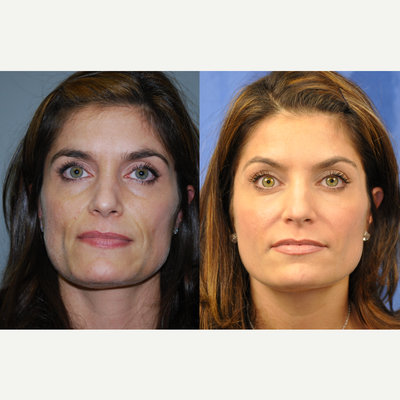 Juvederm before and after photo