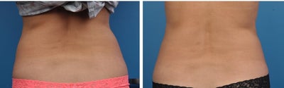 CoolSculpting before and after photo