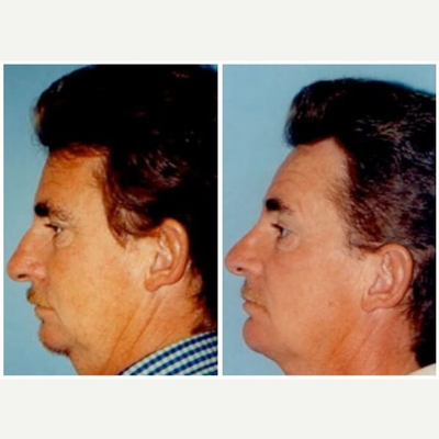 Chin Implant before and after photo