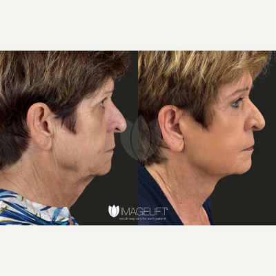 CO2 Laser before and after photo