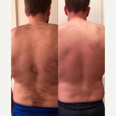 Laser Hair Removal before and after photo