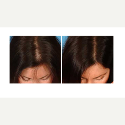PRP for Hair Loss before and after photo