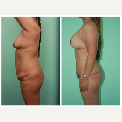 Breast Lift before and after photo