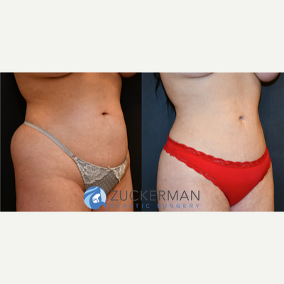 Liposuction before and after photo
