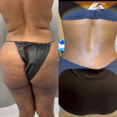 Tummy Tuck before and after photo